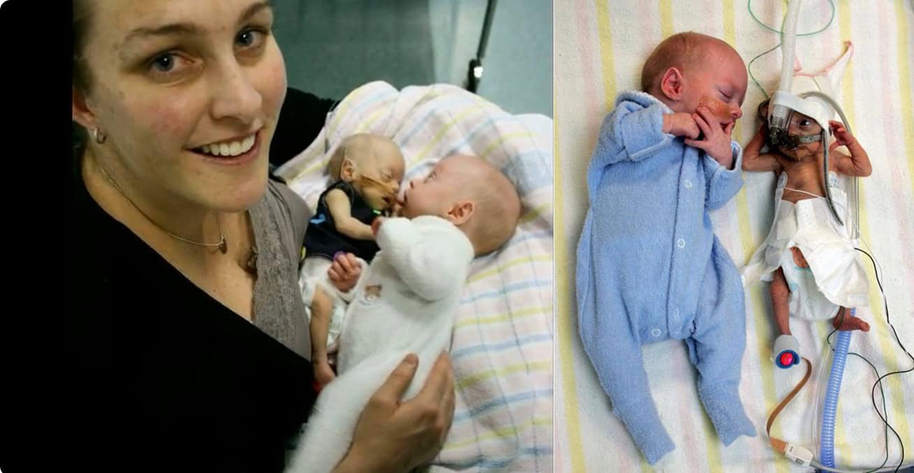 parents reject abortion of one twin 01