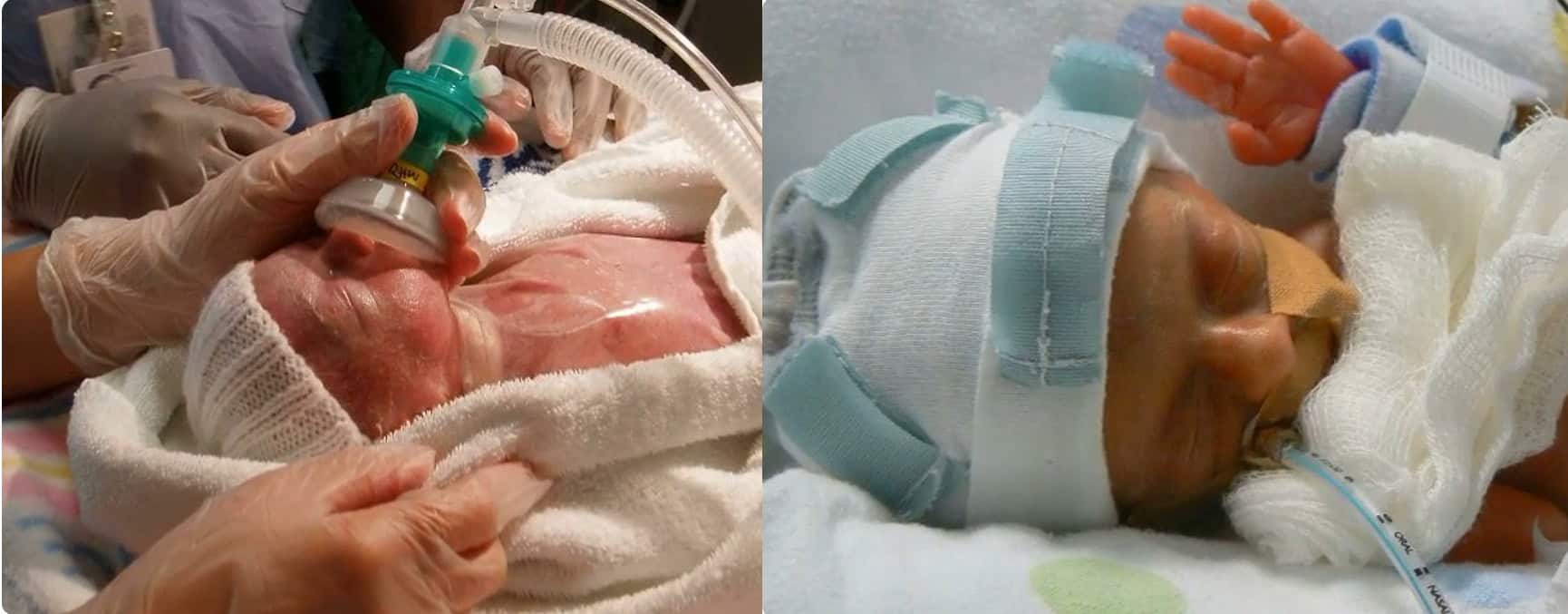 parents reject abortion of one twin 01