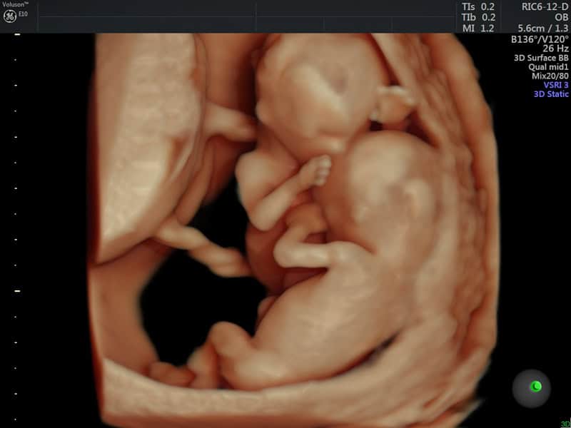 deksioxeiras i aristeroxeiras 02