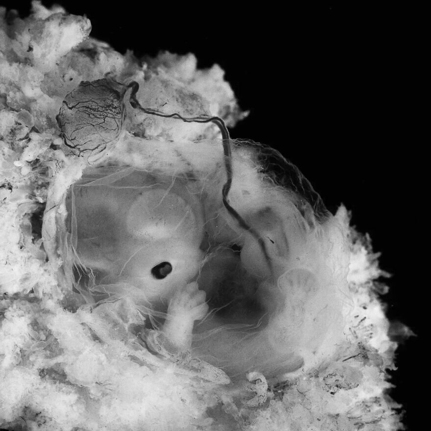 lennart nilsson fetus photography 02