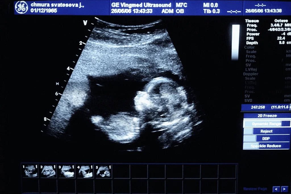 seeing ultrasounds before abortions upset sonographers 02