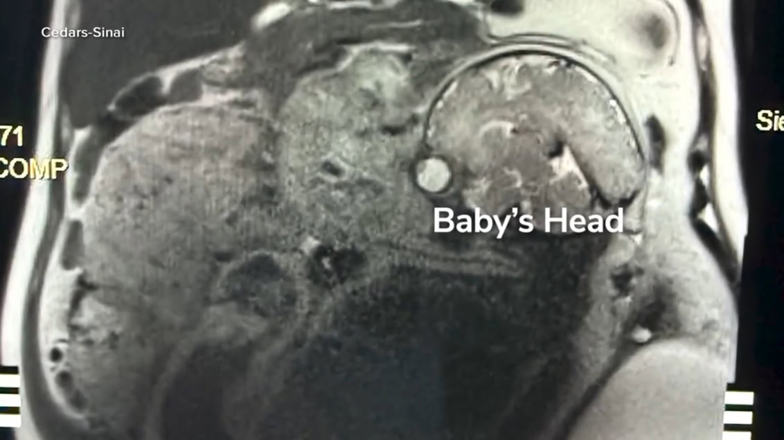 cedars sinai doctors deliver healthy baby in extremely rare abdominal ectopic pregnancy 02