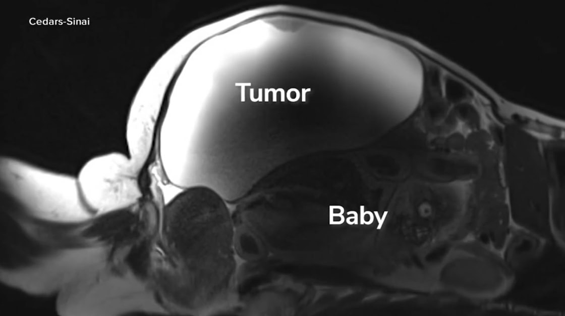 cedars sinai doctors deliver healthy baby in extremely rare abdominal ectopic pregnancy 02